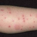 Intepaturile de purici